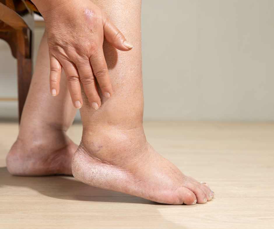 Gambe e mani gonfie come sintomo di eccesso di sodio nella dieta
